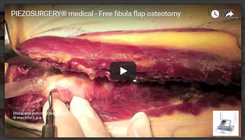 Free Fibula Flap - Dr. Balercia - Ospedali Riuniti - Ancona (IT)