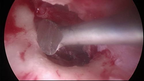 Endoscopic tympanoplasty - step by step - Prof. Marchioni and his equipe - University Hospital of Verona - Italy