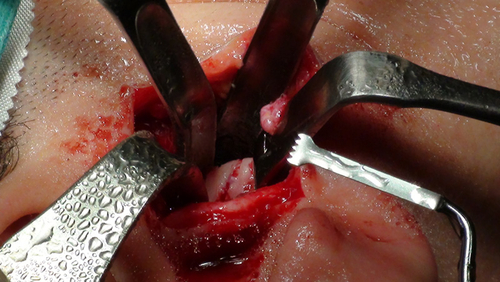 Condilectomy / Eminectomy performed with MT1-20 surgical insert - Dr. Spallaccia, S.Maria Hospital, Terni (IT)