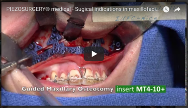 Surgical indications in maxillofacial - Dr. Charles Savoldelli - IUFC - Nice (FR)