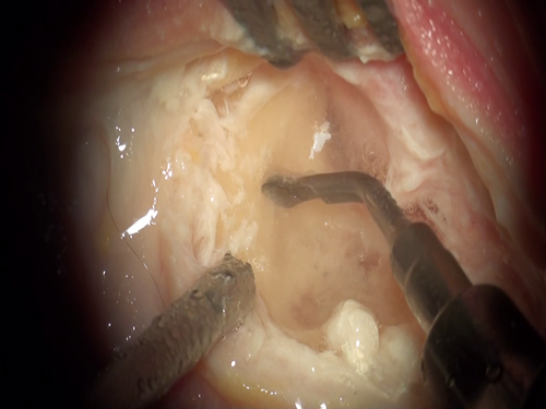 Mastoidectomy perfomed with MP4 + surgical insert