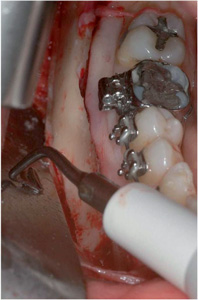 Mandibular angle ostectomy performed with MT2R-4 surgical insert - Prof. Robiony, University Hospital, Udine (IT)