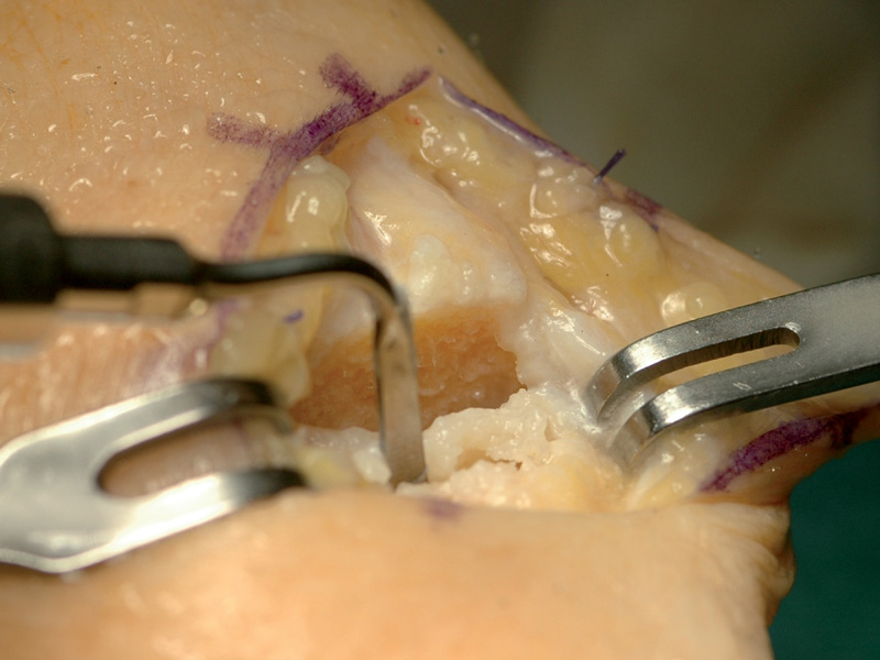 Hand surgery performed by Prof. M.I. Rossello (San Paolo Hospital, Savona, Italy)