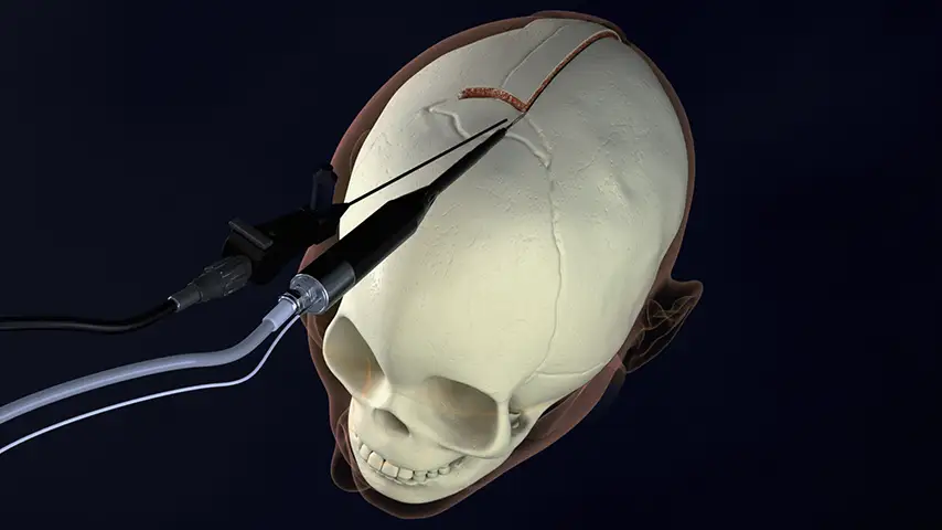 Endoscopic strip craniectomy