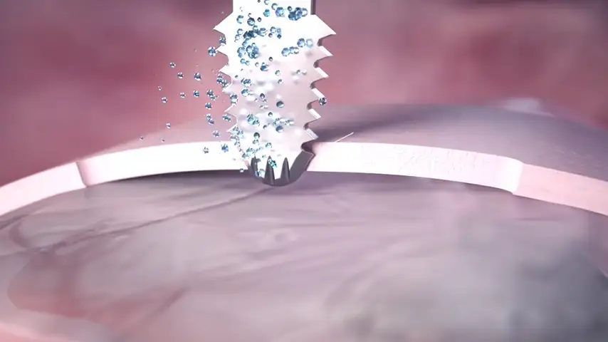 Reduced risk of damaging anatomically complex regions