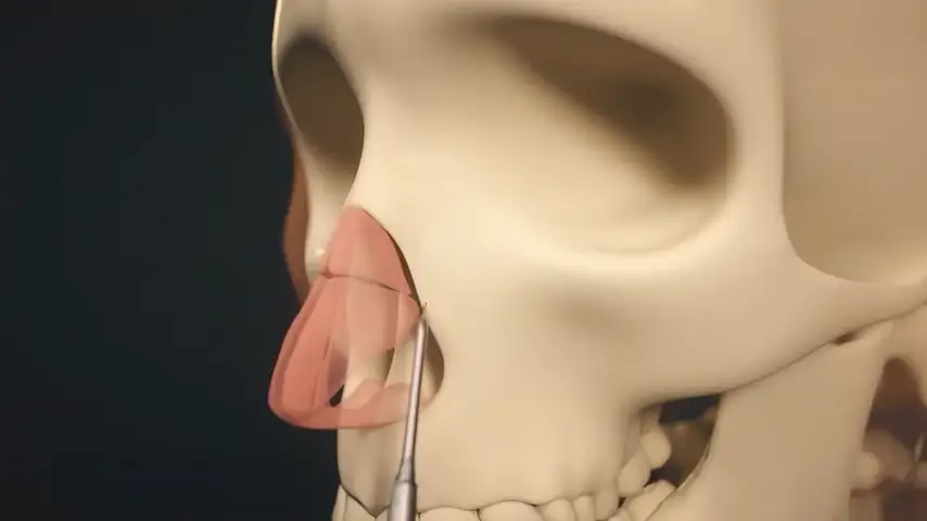 Greater intraoperative control and bone management