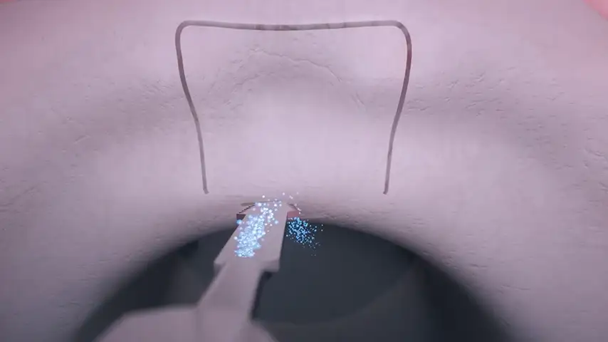 Micrometric cut for minimal bone loss