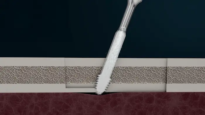 Benefits of Mectron PIEZOSURGERY®