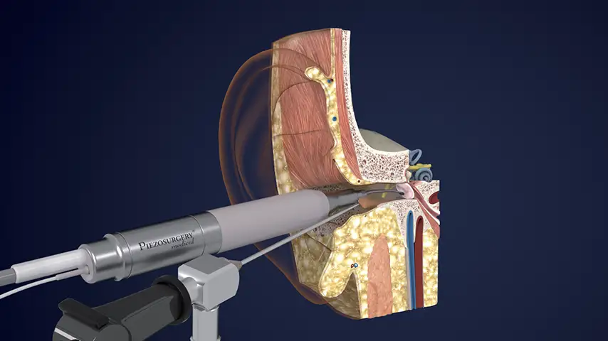 Cholesteatoma and middle ear pathologies