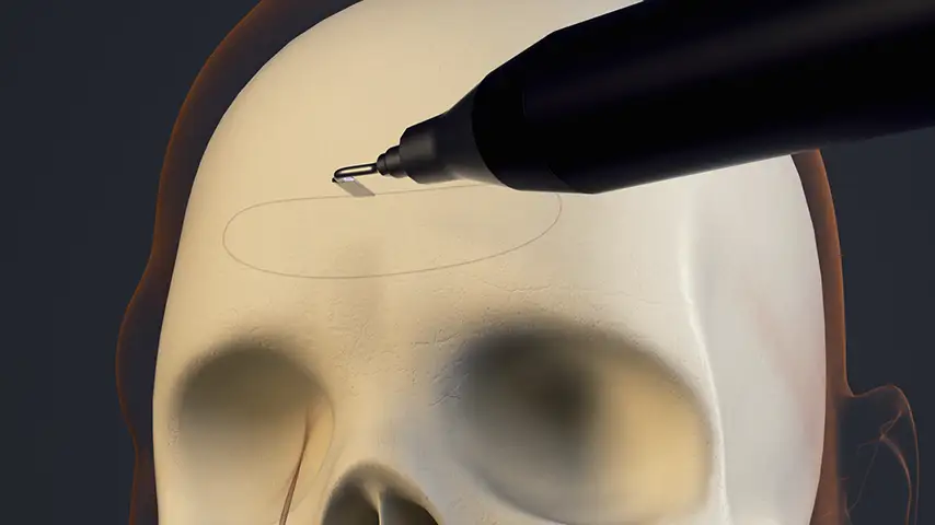 Frontal sinus opening – external approach