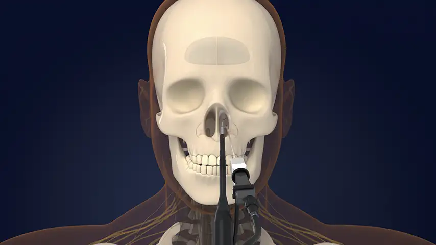 Functional endoscopic sinus surgery