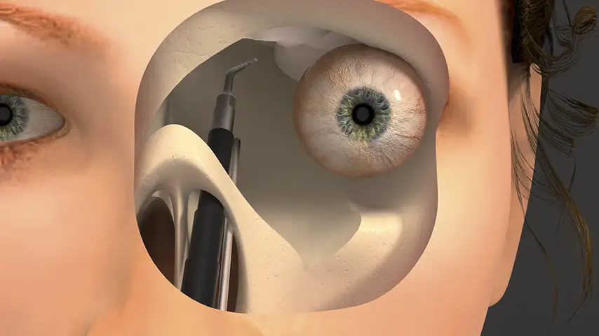 Optic nerve decompression