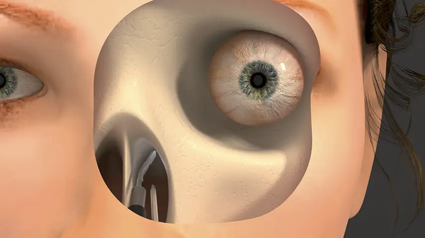 Orbital decompression