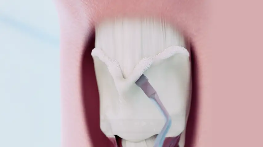 Tracheal shave (TContour®) Tracheal shave (TContour®)