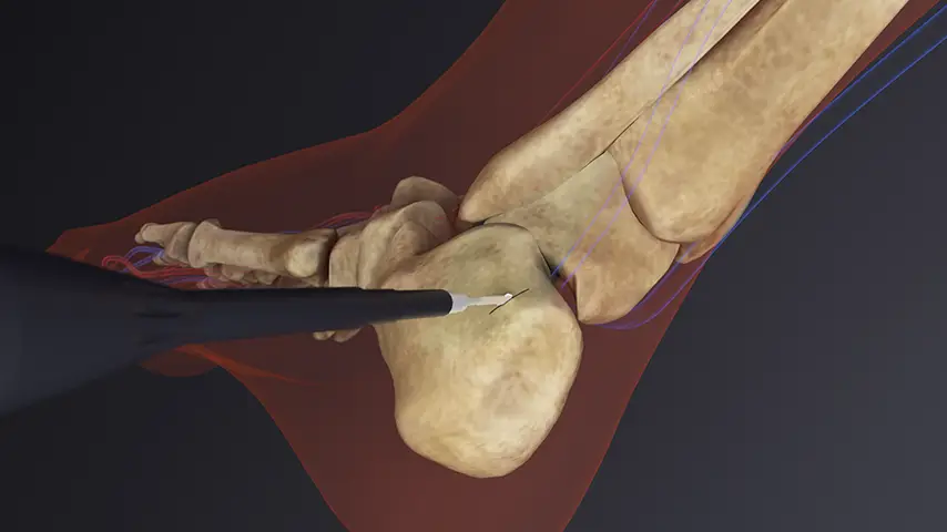 Calcaneal Osteotomy