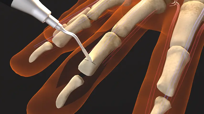 Corrective Osteotomies for Congenital Malformations