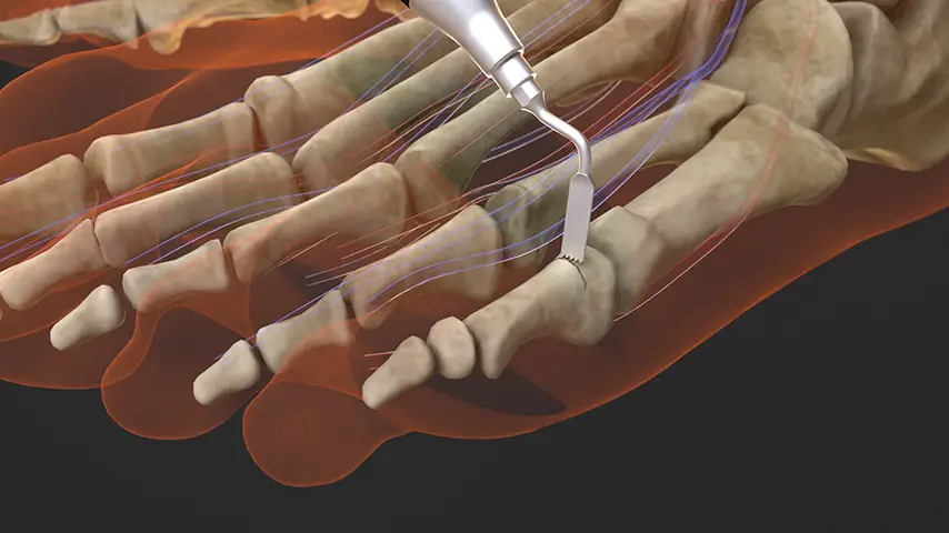 Forefoot Deformity Correction