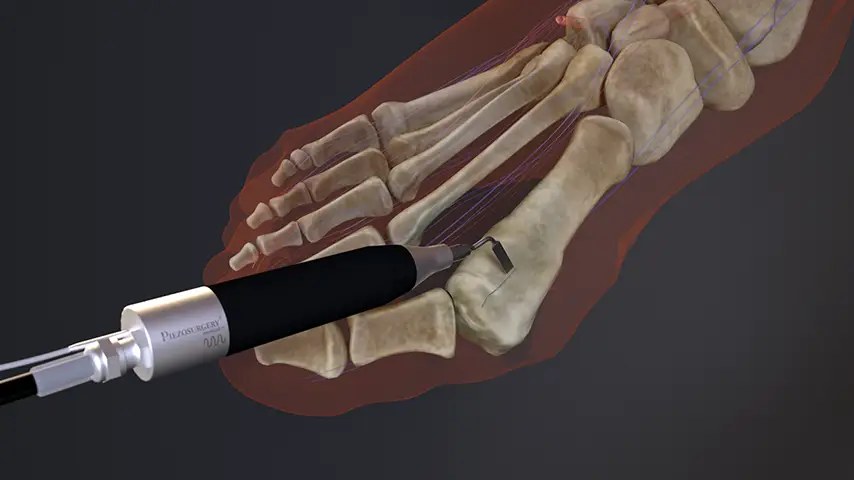 Hallux Valgus Correction