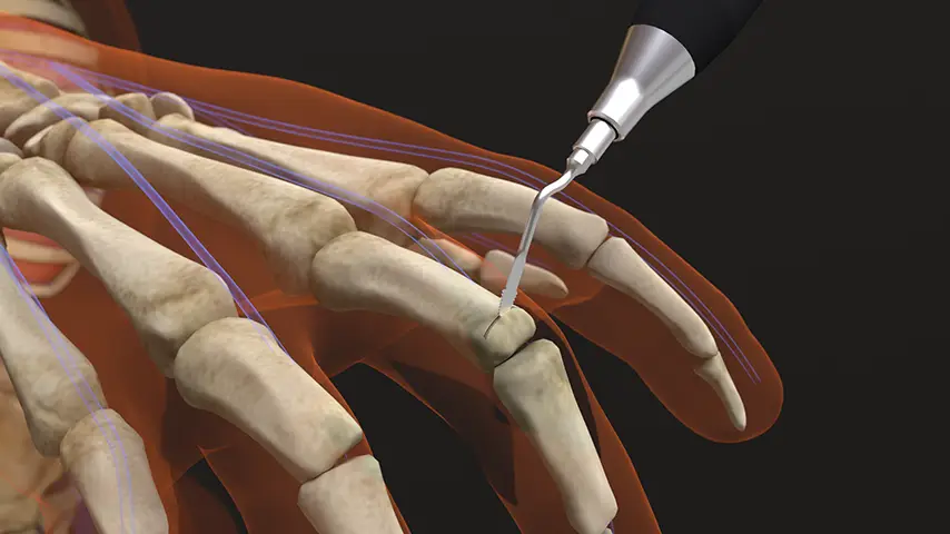Interphalangeal Joint Arthrodesis
